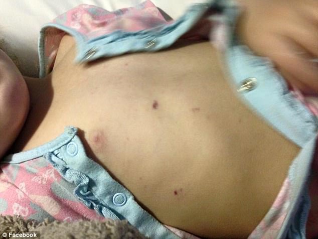 Những hình ảnh gây sốc của căn bệnh viêm màng não mà phụ huynh không thể lơ là - Ảnh 2. Những hình ảnh gây sốc của căn bệnh viêm màng não mà phụ huynh không thể lơ là - Ảnh 2.