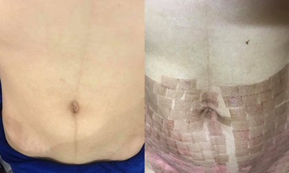 Chi 15 triệu làm đẹp sau sinh ở spa, mẹ trẻ bị bắn laser chín thịt, bụng chi chít sẹo bỏng