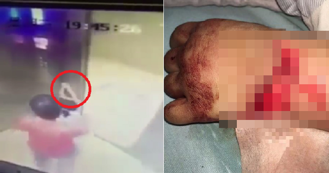 Bé gái bị thương nghiêm trọng khi đi thang máy bởi sai lầm cha mẹ hay gặp phải - Ảnh 2.