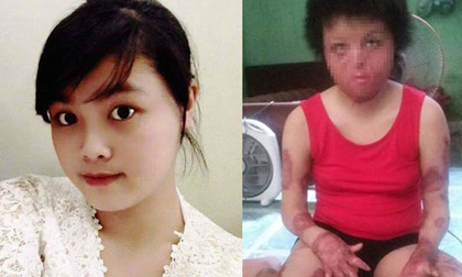 Thiếu phụ xinh đẹp bị chồng tẩm xăng đốt giờ ra sao?
