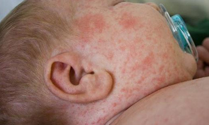 Trẻ sốt đột ngột, cảnh giác với bệnh sốt xuất huyết đang bùng phát