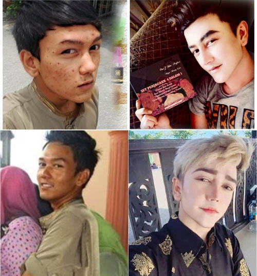 Shock voi khuon mat noi day mun cua chang hot boy dinh dam truoc tham my