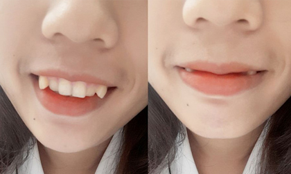 Đến chơi nhà người yêu, cô gái phát điên vì mẹ bạn trai chê 'răng khấp khểnh như ma cà rồng'