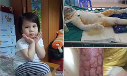 Bé gái 4 tuổi thoát chết kỳ diệu sau vụ bỏng do nhân viên cửa hàng dùng cồn nướng mực