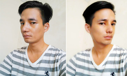 Lệ Rơi tháo băng mũi, lộ diện hình ảnh đẹp như soái ca