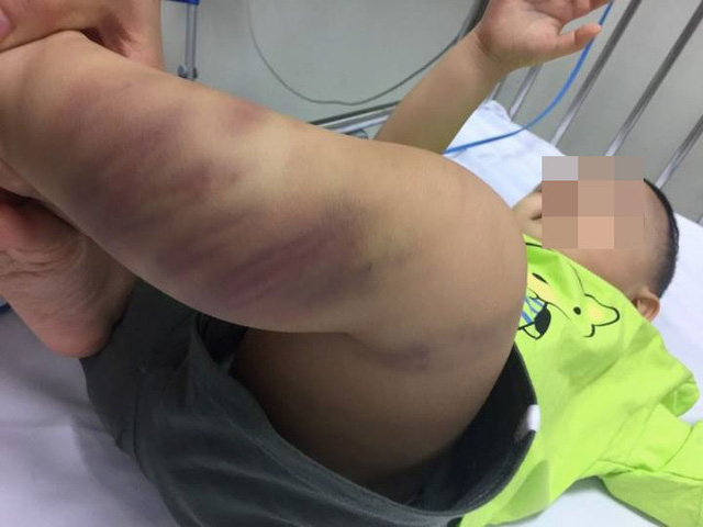 Sức khỏe cháu bé 1 tuổi nghi bị bạo hành dã man đã khá lên hình ảnh 1 suc khoe chau be 1 tuoi nghi bi bao hanh da man da kha len hinh anh 1