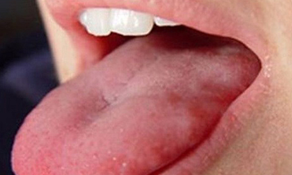 Biểu hiện không ngờ cảnh báo ung thư vòm họng cần đi khám gấp đừng nhầm lẫn với viêm họng 