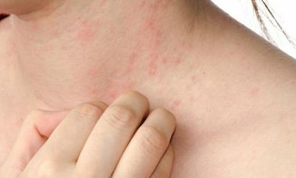 2 dấu hiệu chẳng ai ngờ báo ung thư da nghiêm trọng