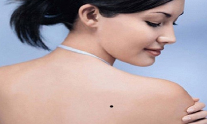 5 tướng nốt ruồi đại phú quý sau lưng đừng bao giờ xóa bỏ