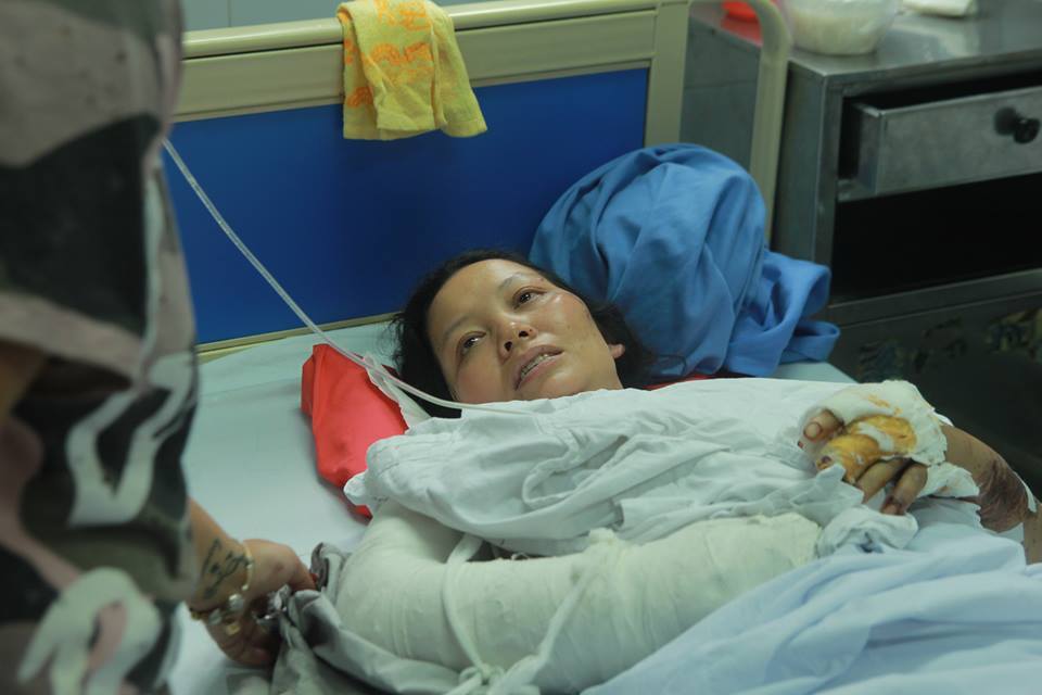 chau be bi cut hai chan trong vu sat lo da o son la gio ra sao? hinh anh 2