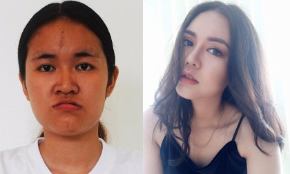 Câu chuyện bi thương đằng sau ca phẫu thuật thẩm mỹ xuất sắc của cô gái từng có bộ hàm như cá piranha