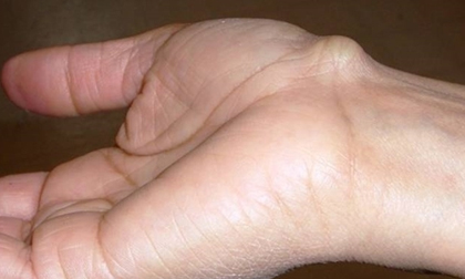 Thấy tay có dấu hiệu này đến viện ngay kẻo hối hận thì đã quá muộn