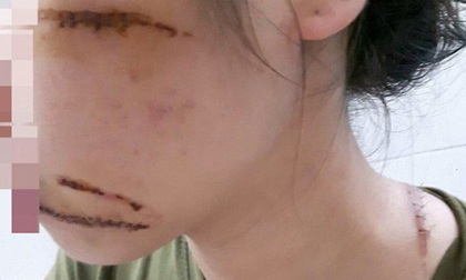 Nhân viên spa bị nhóm côn đồ lao vào chém phải khâu 21 mũi