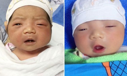 Kỳ lạ em bé ở HN vừa chào đời đã có một chiếc răng, được ví như 'miệng ngậm ngọc'