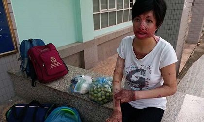 Cô gái bị chồng tẩm xăng đốt: 'Không dám gặp con vì sợ con hoảng loạn khi nhìn thấy mẹ'