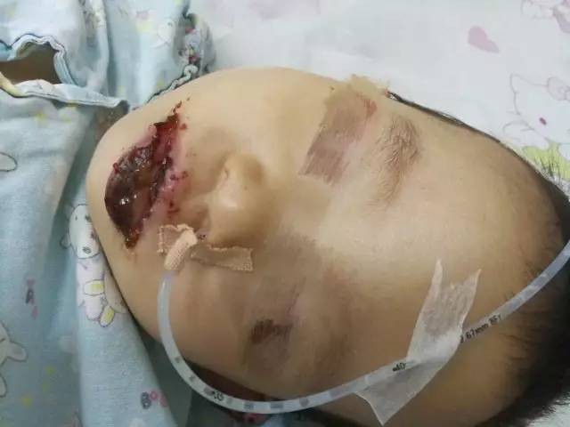 be gai 2 tuoi tq bi bong toan bo mieng vi an nham goi tay long may giat - 1