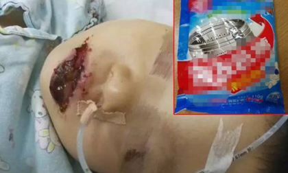 Bé gái 2 tuổi TQ bị bỏng toàn bộ miệng vì ăn nhầm gói tẩy lồng máy giặt