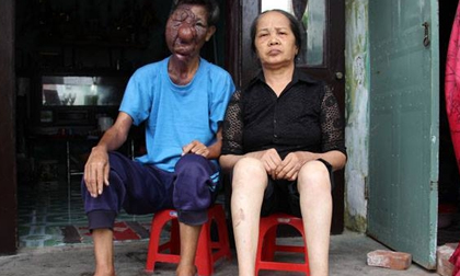 Chuyện tình cảm động của ông lão ăn xin có khuôn mặt biến dạng
