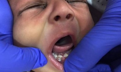 Em bé đầu tiên trên thế giới vừa lọt lòng mẹ đã có 7 chiếc răng