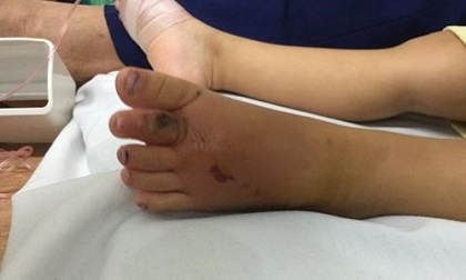 Trẻ nhỏ liên tiếp nhập viện vì bị rắn độc cắn, nhiều ca nặng có dấu hiệu hoại tử