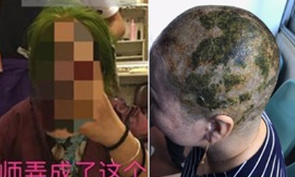 Nhuộm tóc 4 lần trong 7 tiếng để có màu xanh lá, người phụ nữ bị sốc phản vệ và cái kết không mong muốn