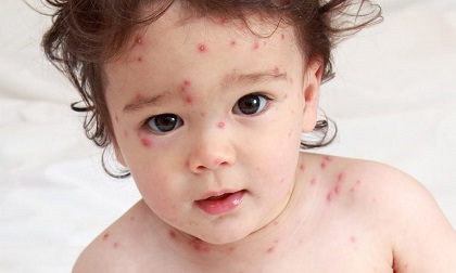 Các chứng bệnh thường gặp ở trẻ sơ sinh trong tuần lễ đầu sau sinh