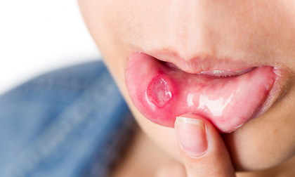 Nếu thấy biểu hiện này đừng nghĩ nhiệt miệng hãy tới bệnh viện khám ung thư ngay