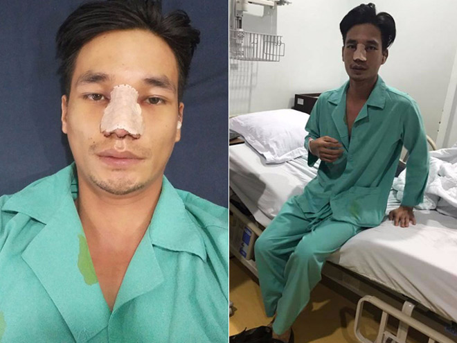 Chán mũi nhân tạo, Lệ Rơi lại sửa để tìm về diện mạo ban đầu - 1