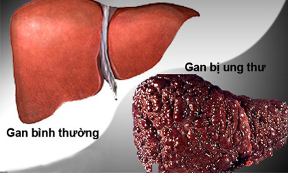 Dấu hiệu quan trọng cảnh báo bệnh gan đang tiến triển trong cơ thể, nếu có thì hãy đi khám