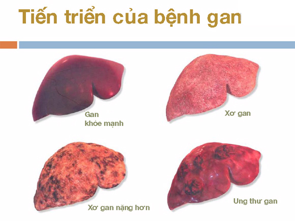 benh-gan-1010-xahoi.com.vn-w580-h435