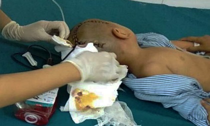 Tin mới vụ bé trai 3 tuổi ngã ở trường mầm non: Bé bị xuất huyết não, phải mổ gấp