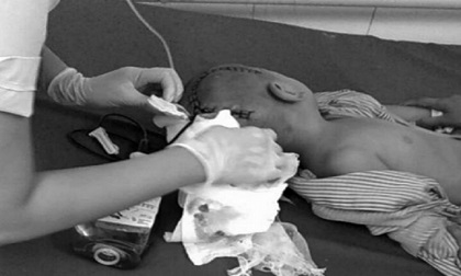 Gửi ở trường mầm non, cháu bé 3 tuổi bất ngờ bị chảy máu não