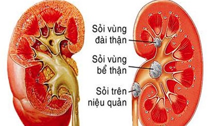 Sốc: Bé mới 3 tuổi đã mắc sỏi tiết niệu chỉ vì nguyên nhân chẳng ai ngờ