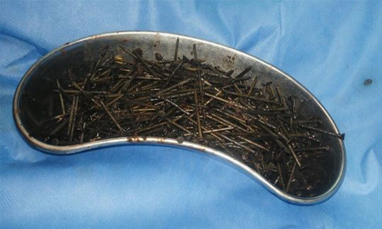 Dùng nam châm hút 600 đinh sắt ra khỏi bụng bệnh nhân