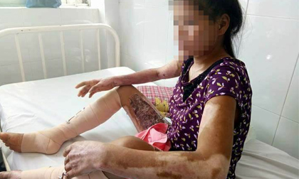 Chồng sắp cưới ôm tiền từ thiện bỏ mặc vợ mang thai bị bỏng nặng