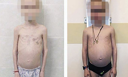 Bé trai 11 tuổi chỉ nặng 12kg vì âm mưu không thể dung thứ của người mẹ nuôi