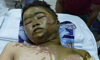 Cha mẹ ly hôn, thiếu nữ 17 tuổi khốn khổ mưu sinh nơi đất khách quê người vì bất ngờ bị tạt axit