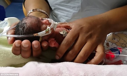 Sinh non nặng 395g, bé gái tí hon gây choáng váng
