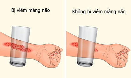 8 dấu hiệu viêm màng não ở trẻ đáng cảnh báo, bố mẹ cần lưu ý