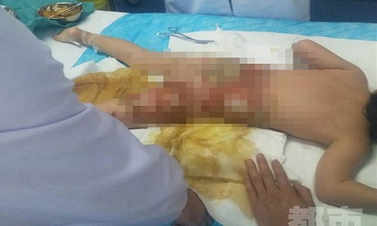 Bé gái 3 tuổi bị bỏng nặng vì xô nước nóng của cô giáo mầm non