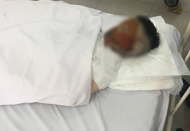 co gai 17 tuoi bat ngo bi tat axit tren duong di lam ve, nguy co mu 2 mat - 1