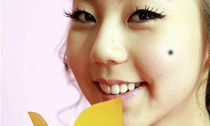 6 vị trí nốt ruồi 'dự báo' đường tình trắc trở ai có thì nên xóa bỏ