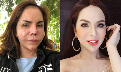 Hotgirl chuyển giới 1 triệu followers bất ngờ chia sẻ ảnh mặt biến chứng sau khi nạo silicon