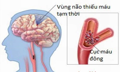 5 bài thuốc dân gian cực tốt cho người bị thiếu máu não