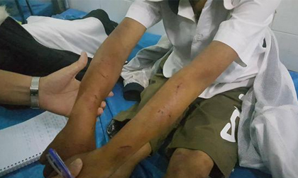 Bé trai 11 tuổi bị bố đánh đa chấn thương: 'Cháu van xin nhưng bố vẫn đánh'