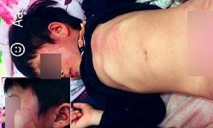 Bé gái 4 tuổi bị đa chấn thương toàn thân, nghi ngờ bị bạo hành ở trường mầm non