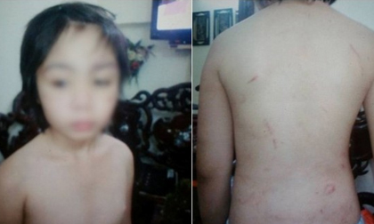 Bé trai 10 tuổi nghi bị bố và mẹ kế bạo hành gãy xương sườn, rạn sọ não