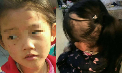 Bé gái 6 tuổi bị mẹ đẻ ngược đãi dã man khiến mặt đầy vết thương, tóc rụng thành mảng lớn