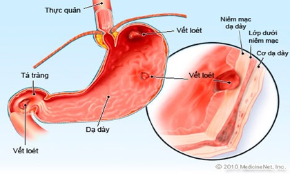 Những thực phẩm đại kỵ với người đau dạ dày