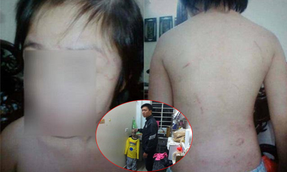 Xót xa lời kể bé 10 tuổi bị bố, mẹ kế bạo hành: 3 lần bỏ trốn mới thoát nạn